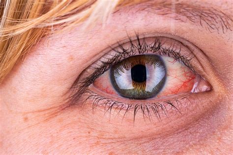 Red Eyes Causes Treatment And Tips