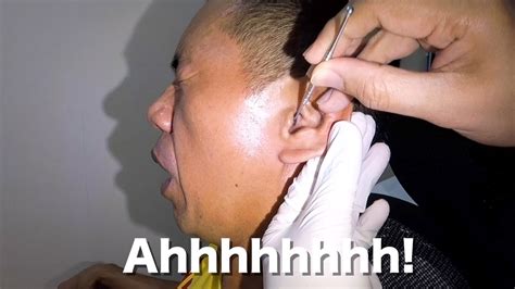 Mans Massive Earwax Removal Youtube