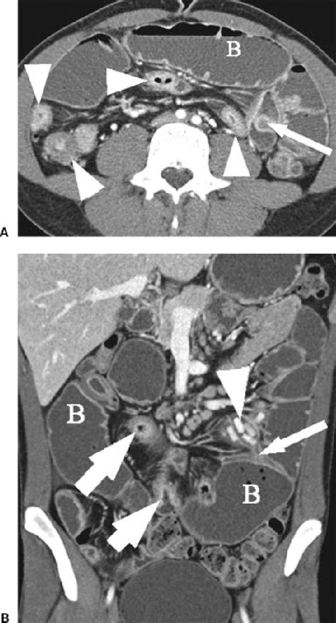 A Computed Tomography Enterography Cte Of Multiple Obstructing