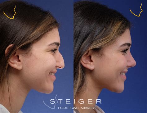 Rhinoplasty Before And After Droopy Tip Steiger Facial Plastic