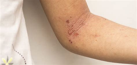 Intertrigo Intertriginous Dermatitis Symptoms Causes Drugs Etc