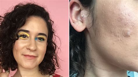 Wearing Pimple Patches In Public Helps Me Accept My Cystic Acne Allure