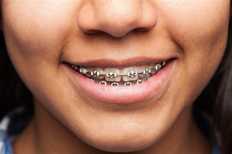 Fordent Odontologia Conheça Os Principais Tipos De Aparelhos Dentários Fixos E Escolha O Seu
