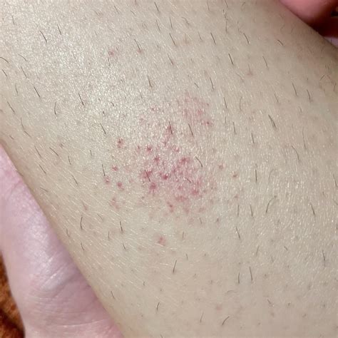 Petechiae On My Lower Leg Should I Be Worried Askdocs