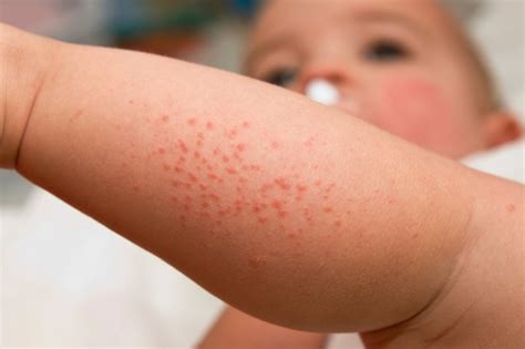 Common Skin Problems In Children Starmommy