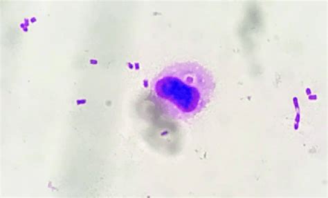 Gram Staining Of Urine Specimens Showing Phagocytosed Gram Negative Rod