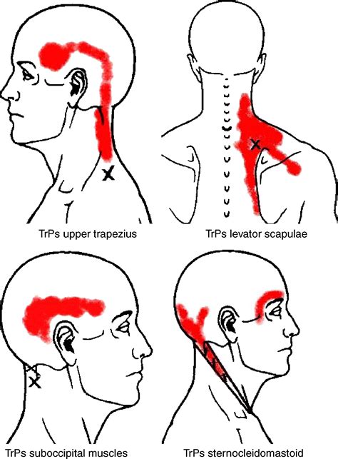 Myofascial Trigger Points In Subjects Presenting With Mechanical Neck