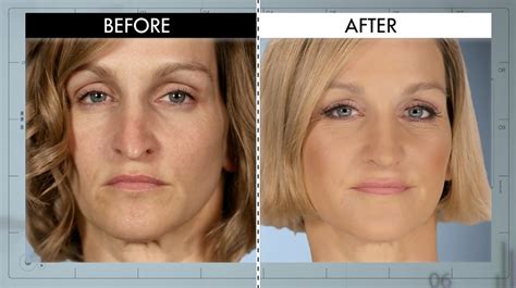 A Shorter Straighter Nose From Botched Patients Before And After