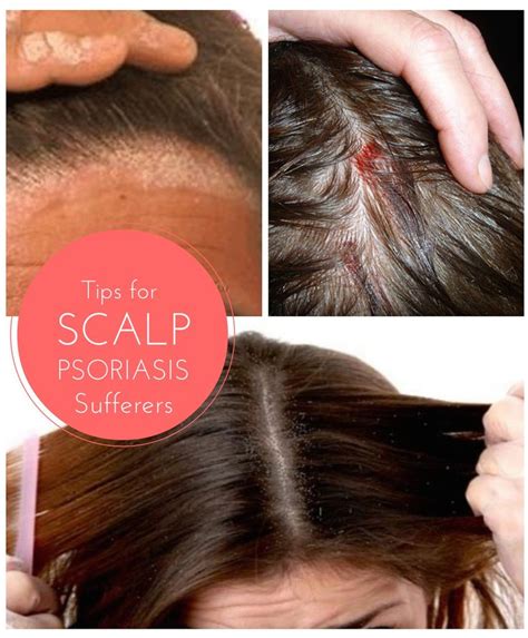 Scalp Psoriasis Is A Relatively Common Condition Affected Around Of Australians It Is