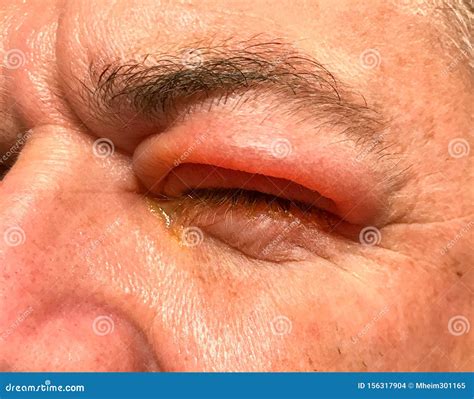 Detail Of Badly Swollen Upper Eyelid Of A Man Stock Photo Image Of