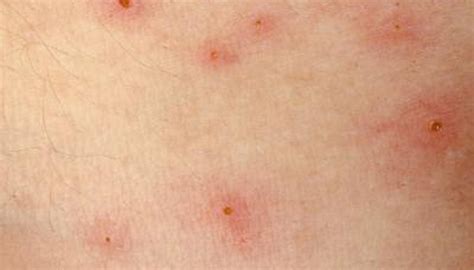 What Are Raised Bumps On The Skin Healthy Living