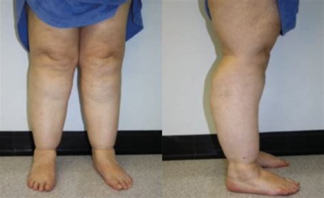 Lipoedema A Long Term And Complex Condition That Affects Women