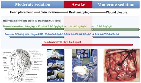 12 Motor Mapping Rolandic Pre Rolandic And Insular Cortex Neupsy Key