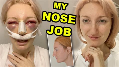 MY NOSE JOB PART RHINOPLASTY SEPTOPLASTY SURGERY RECOVERY YouTube