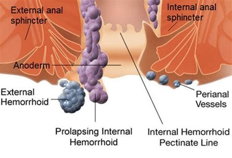 Hemorrhoids Internal External Symptoms Causes Treatment