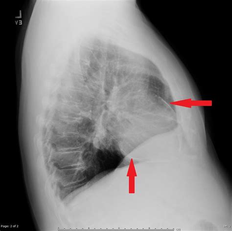 Pericarditis is a heart condition in which the pericardium (the sac around your heart) is inflamed. Tuberculous pericarditis x ray - wikidoc