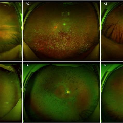 Ultra Widefield Fundus Images And Corresponding Heatmaps Showing