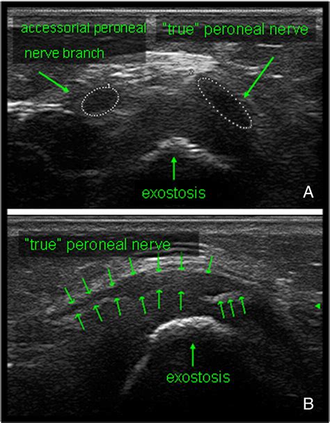 Common Peroneal Nerve Ultrasound Hot Sex Picture