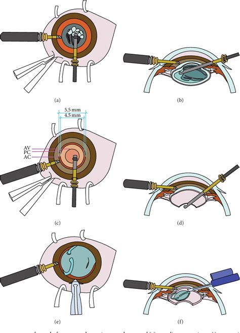 Figure 1 From Comparison Between Limbal And Pars Plana Approaches Using