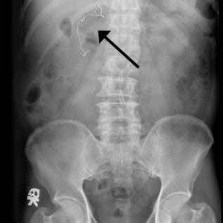 The Plain Film Radiograph Plain Abdominal X Ray Shows A Retained Download Scientific Diagram