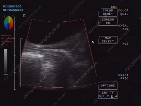 Sexual Intercourse Ultrasound Footage Stock Video Clip K Science Photo Library