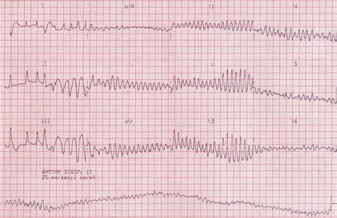 Ventricular Flutter Litfl Ecg Library Diagnosis Hot Sex Picture