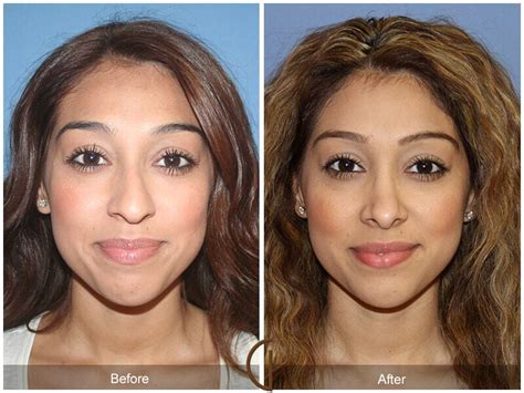 Ethnic Rhinoplasty Before After Photos From Dr Kevin Sadati