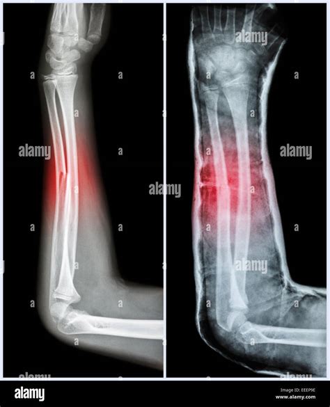 Fracture Shaft Of Ulnar Bone Forearm Bone Left Pre Treatment