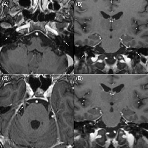 Axial And Coronal T1 Post Gadolinium Mri Brain Showing Abnormal
