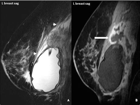 Full Text A Case Report Of Breast Implant Associated Anaplastic Large