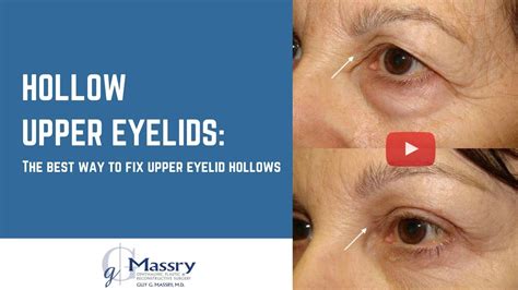 surgery for hollow upper eyelids dr guy massry youtube