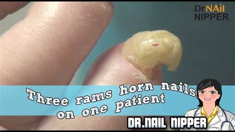 Rams Horn Archives Dr Nail Nipper