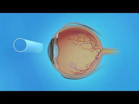 A retinal tear is a hole that forms in the outer part of the retina (figure 1, arrow 1) prevent the retina from detaching. Retinal Tear Treatment - Laser Photocoagulation - YouTube