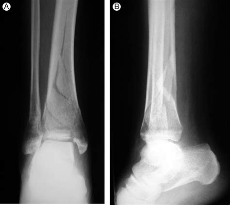 Arthroscopically Assisted Reconstruction And Percutaneous Screw