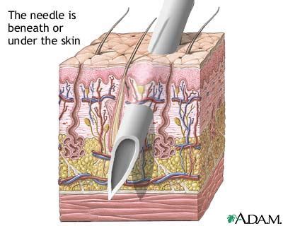 Learn the safest and most effective way to give your pet a subcutaneous (under the skin) injection at home. Skin layers and needles: MedlinePlus Medical Encyclopedia ...