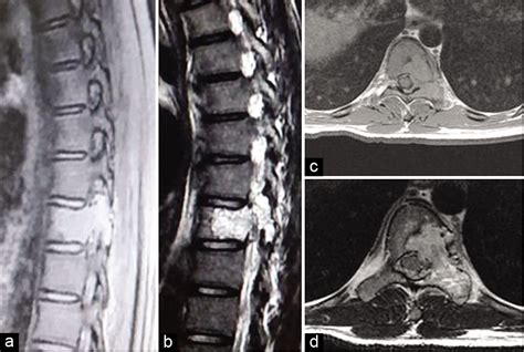 Aneurysmal Bone Cyst Spine