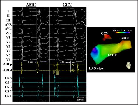 Figure 1 From Eccentric Activation Patterns In The Left Ventricular