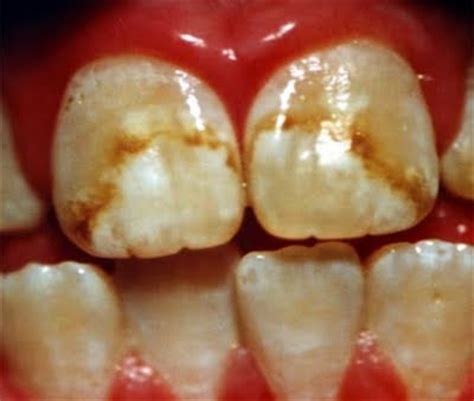 teeth discolored part  intelligent dental