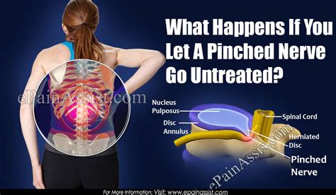 What Happens If You Let A Pinched Nerve Go Untreated