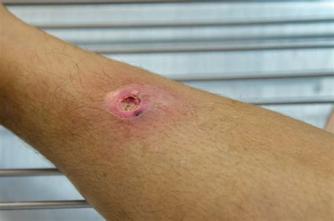 Antibiotics Increase Cure Rate From Small Skin Abscesses Compared With