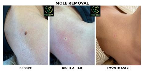 Mole Removal Near Me Prices Long Record Custom Image Library
