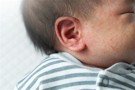 Baby Eczema Symptoms Treatment Causes And Does Your Baby Have It