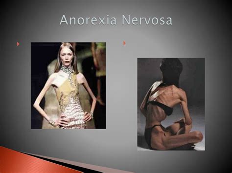 Ppt Anorexia Nervosa Powerpoint Presentation Free Download Id3061859