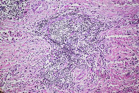 Eosinophilic Granuloma Of Human By Stocksy Contributor Pansfun