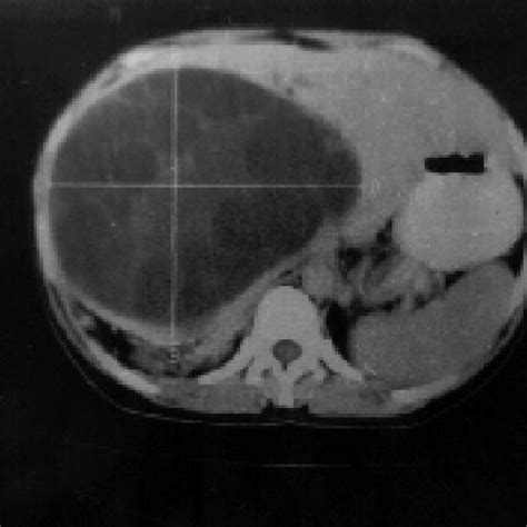 Computed Tomographic Ct Scan Displays A Large Hydatid Cyst In The