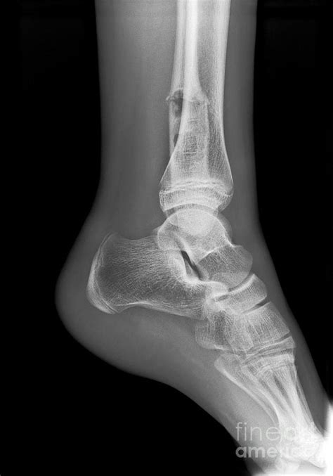 Ankle Fracture With Bone Cyst X Ray Photograph By Science Photo