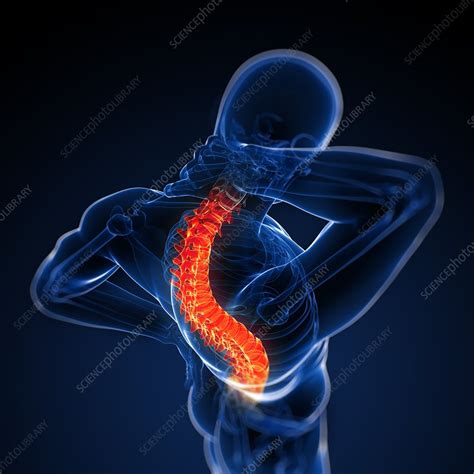 Back Pain Conceptual Artwork Stock Image F0041234 Science Photo