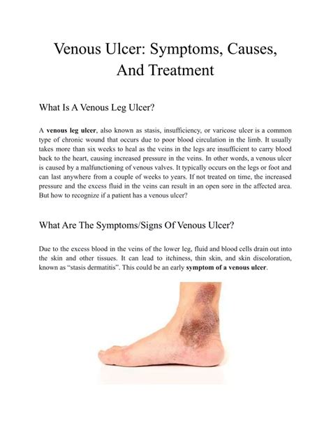 Ppt Venous Ulcer Symptoms Causes And Treatment Powerpoint Presentation Id