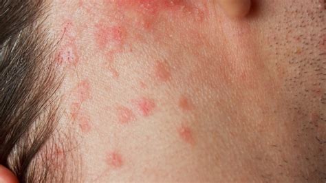 What Causes Itchy Rash On Scalp