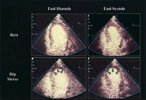 Stress Echocardiography Current Methodology And Clinical Applications